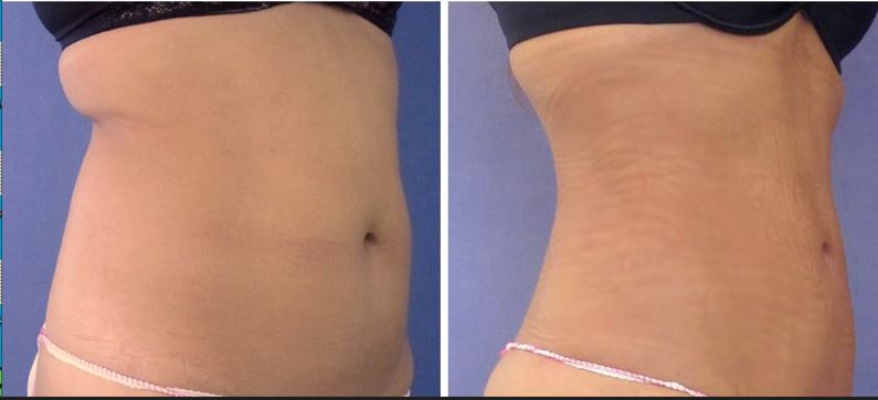 liposuccion abdomen complet et dos femme