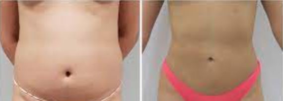 liposuccion ventre femme Turquie